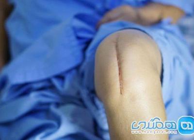 10 مورد مهمی که باید قبل از عمل زانو بدانید