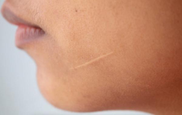 یک مطالعه نو نشان می دهد که پیوند فولیکول مو می تواند جای زخم را از بین ببرد